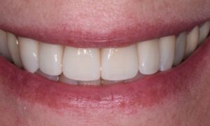 All porcelain crowns to replace multiple old and stained fillings.
