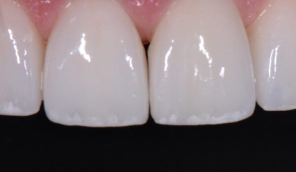 Fill open spaces and fix chipped enamel with porcelain veneers.