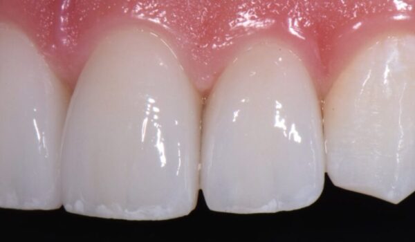 Fill open spaces and fix chipped enamel with porcelain veneers.