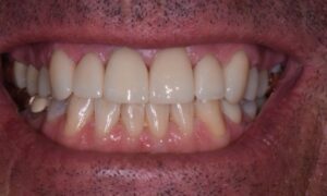 Replace old metal-based front crown with an all porcelain crown and veneers on front teeth.