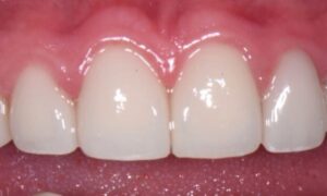 Decayed and discolored teeth after braces treated with porcelain veneers.