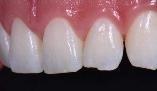 Fill open spaces and fix chipped enamel with porcelain veneers.