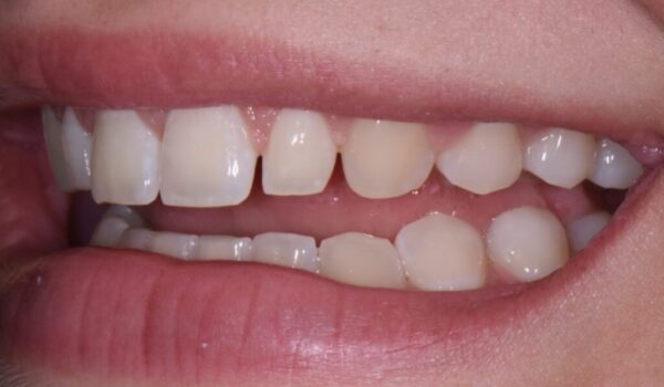 Veneers to correct the size of peg lateral incisors.