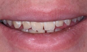 Decayed and discolored teeth after braces treated with porcelain veneers.