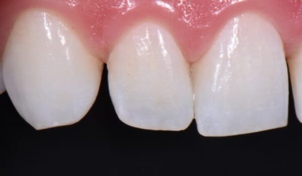 Fill open spaces and fix chipped enamel with porcelain veneers.